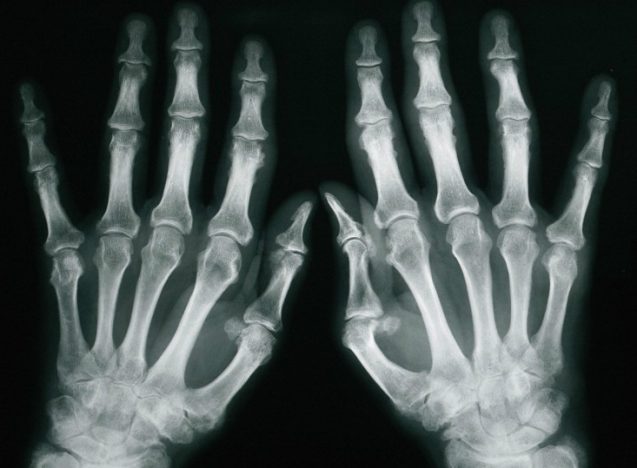 דלקות פרקים, נעים להכיר?